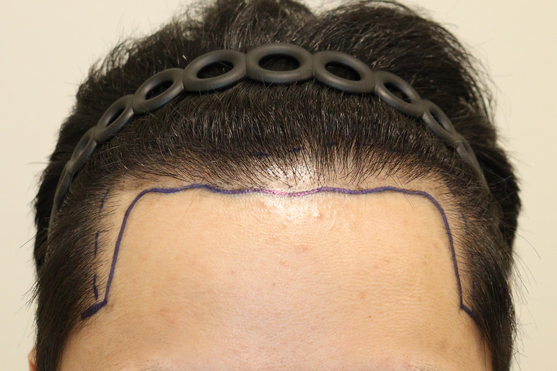Daegu Hair Clinic Hair Transplantation 1400m Non-Cutting No Cut 1 Year Has elapsed