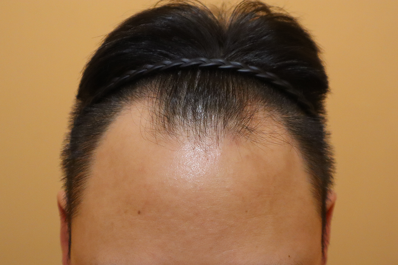 헤어로의원 부산점 비절개 모발이식 3400모 15일 경과