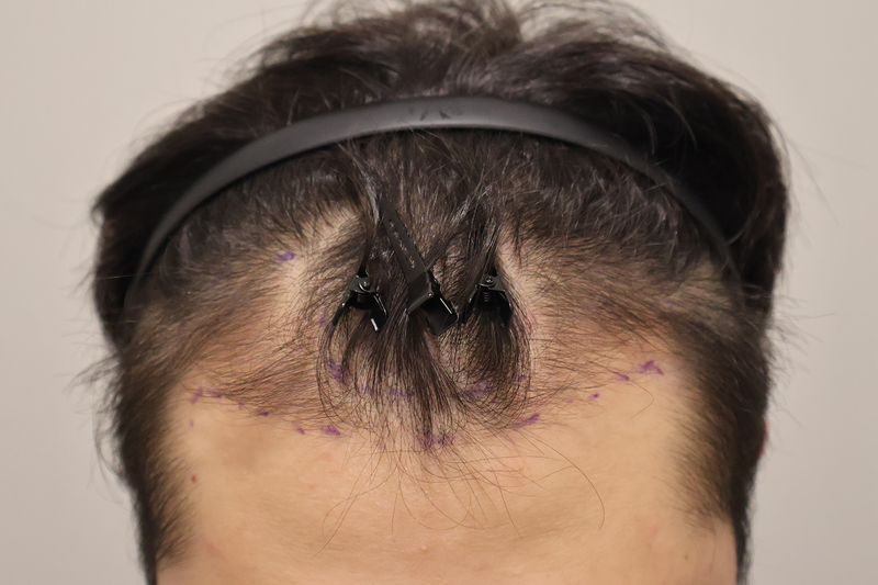 Busan Hairo Clinic Non-Cutting 1400 Hair follicle Transplantation 2 Weeks and Late Periods