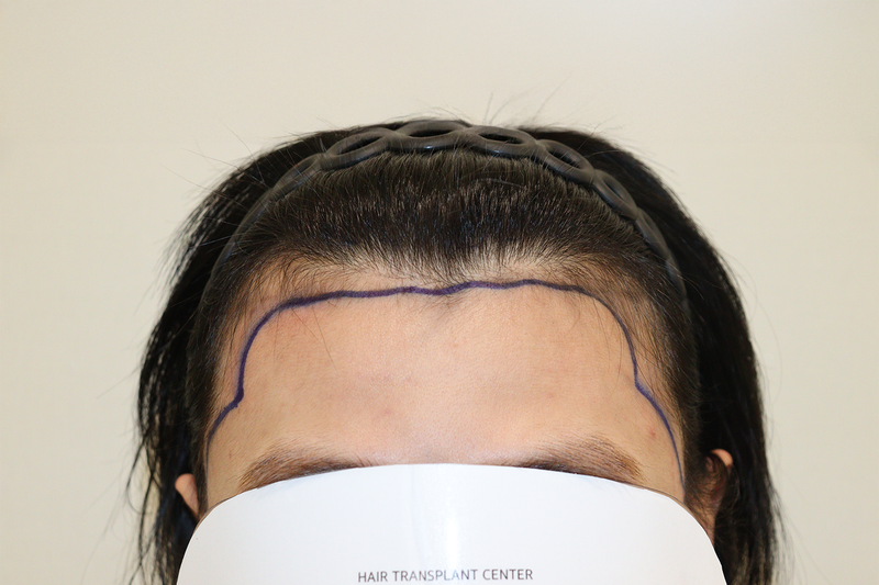 大邱ヘアロ医院2600本、2週間経過後の納期です