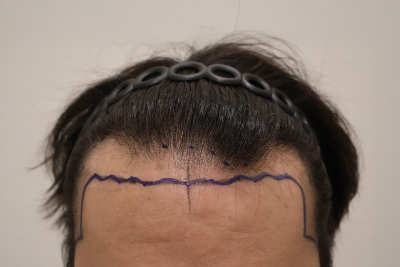 東灘ヘアで3600毛の鼻切開手術直後