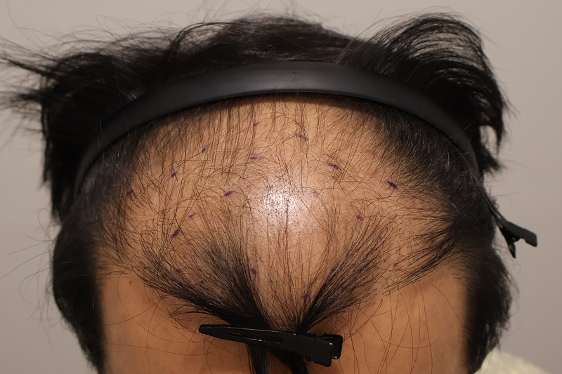 Busan Hair for Two Weeks of Non-Cutting Hair Transplantation 900 Hair follicles