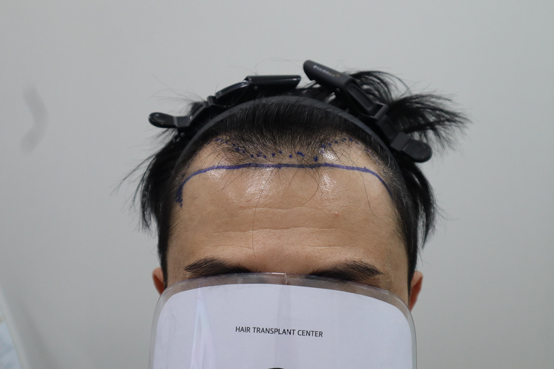 全州ヘアロ医院の非切開毛髪移植3700本の直後のレビューです。