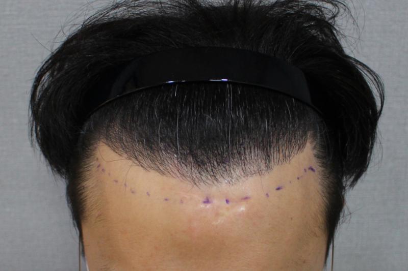 仁川マイモ 植毛1年体験談