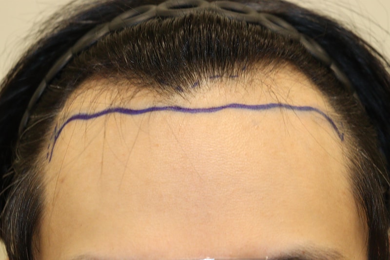 大邱 ヘアロ医院 非切開 毛髪移植 3000本の手術から9ヵ月経過