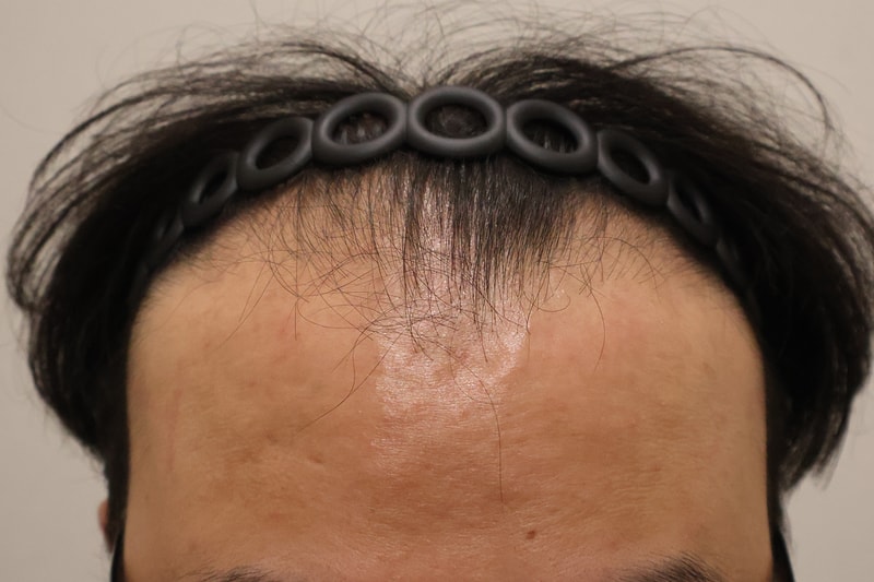 ドンタンヘアロ医院3600毛手術後10日目