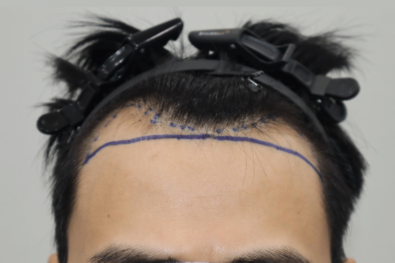 全州ヘアロ医院の非切開毛髪移植、3300本の毛髪移植を受けてきました