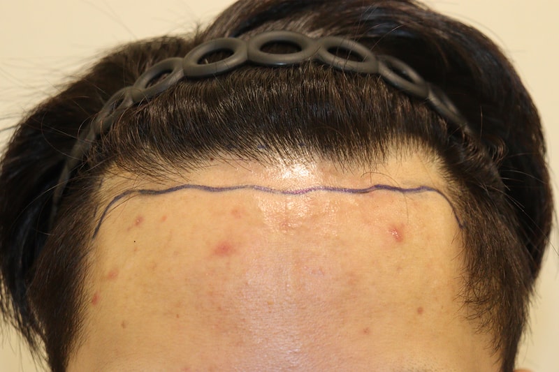 Review of non-intersected 2200 hair transplantation with Daegu Hair