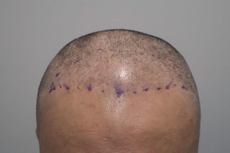 Incheon Maimo Clinic's 1500 Hair follicles 2 Weeks and Review