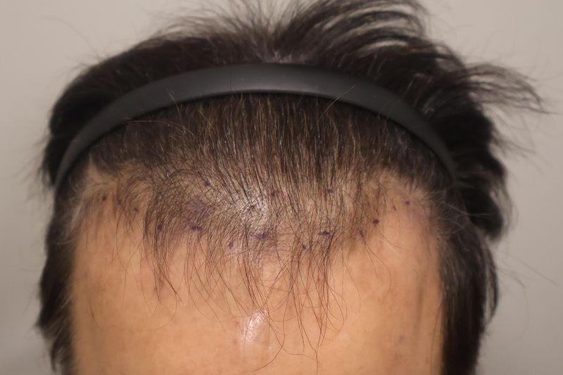 1100 hair follicle crown + M shape 1 month after non-cut hair transplantation with Busan hair