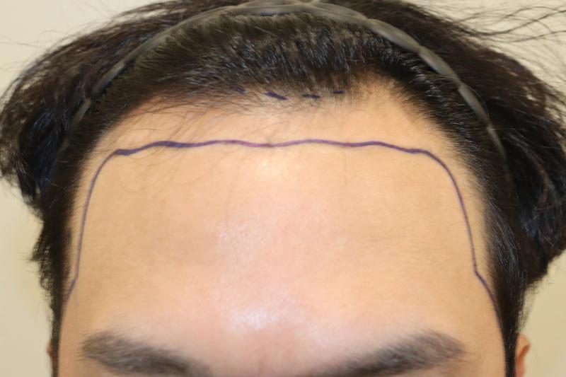 Daegu Hairo Clinic 3300 hair incision hair transplant 2 weeks later!