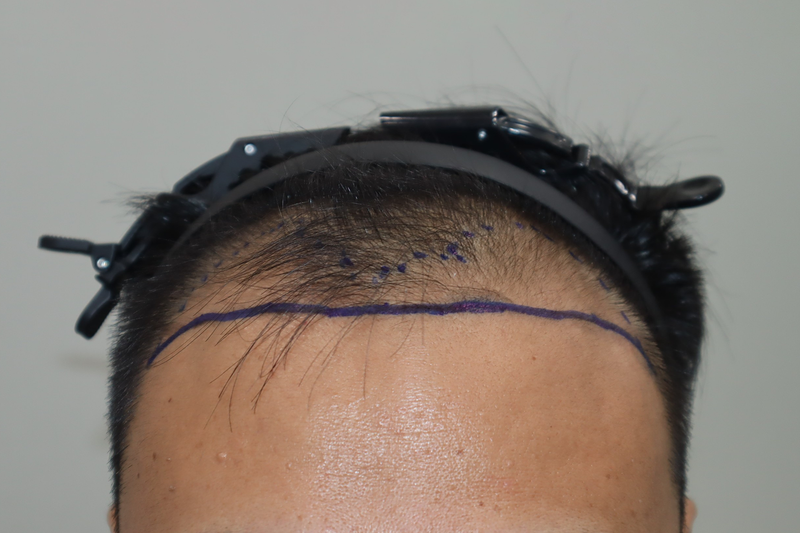 全州毛发英雄 医院栽植3400株，经过2周