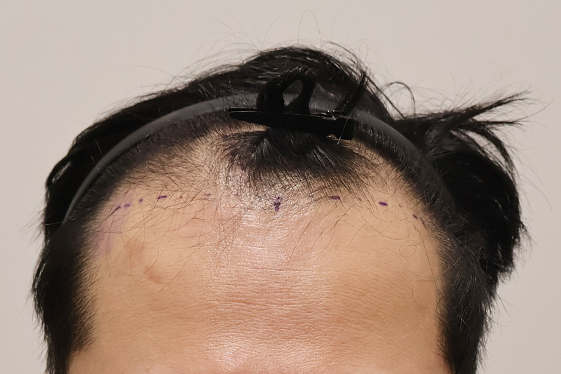 부산 헤어로의원 1200모낭 3개월 후기