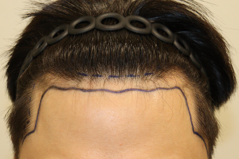 Daegu Hair Clinic's Non-Cutting Hair Around 2 Weeks of 2400 Hair