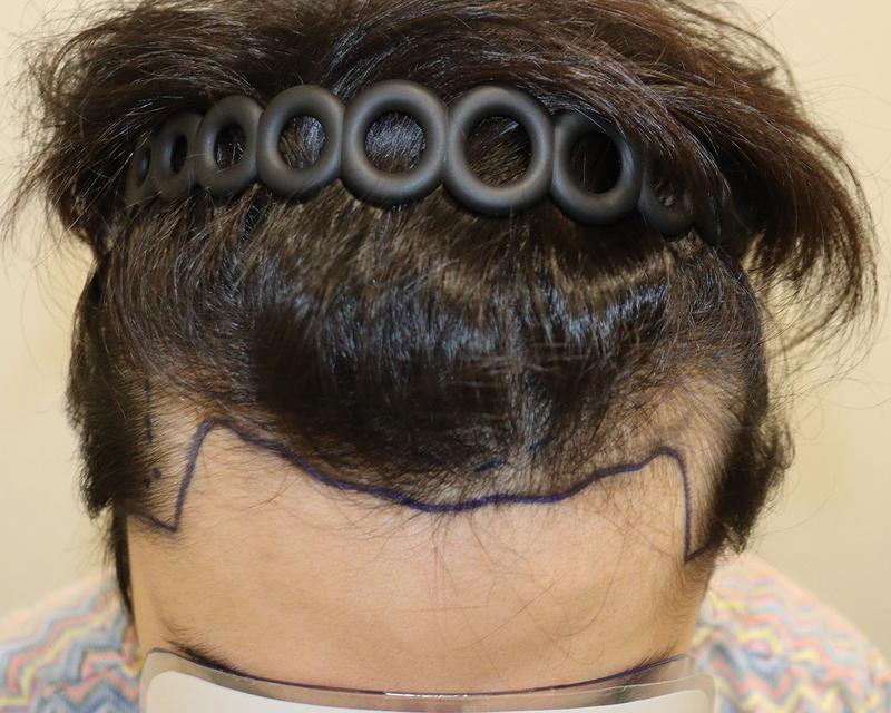 Daegu Hair Orphan Clinic Hair Transplantation Non-Cutting Two Block 2200 Mo 2 Weeks Later