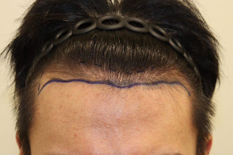大邱 ヘアロ医院 非切開 ノーカット2200毛 毛髪移植 1年経過後のレビュー