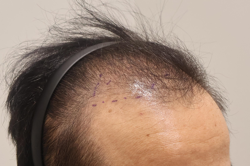 A review of 1600 hair follicles in Busan Hairo Clinic after 1 month
