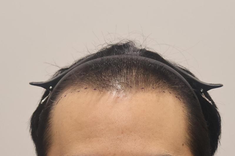 This is the second week of Incheon Maimo Clinic's 1400 hair follicles.