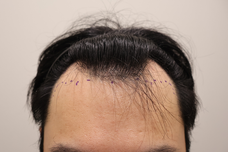 인천 마이모의원 1100모낭 비절개 3개월 후기