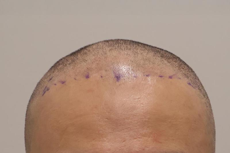 Incheon Maimo Clinic 1500 Hair follicles after 3 months