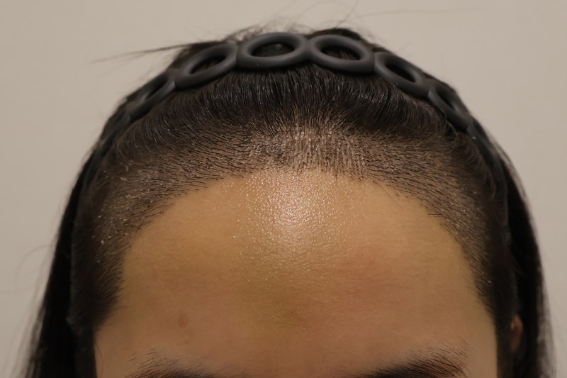 東灘ヘアで切り開きで3400本植え10日後記