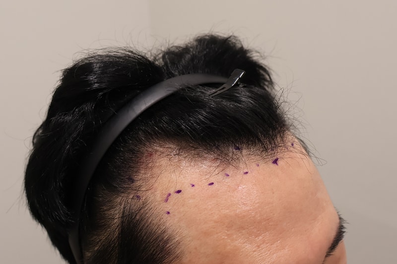 인천 마이모 한달차 홀랑 다 빠졌지만 믿음으로 기다립니다 ^^