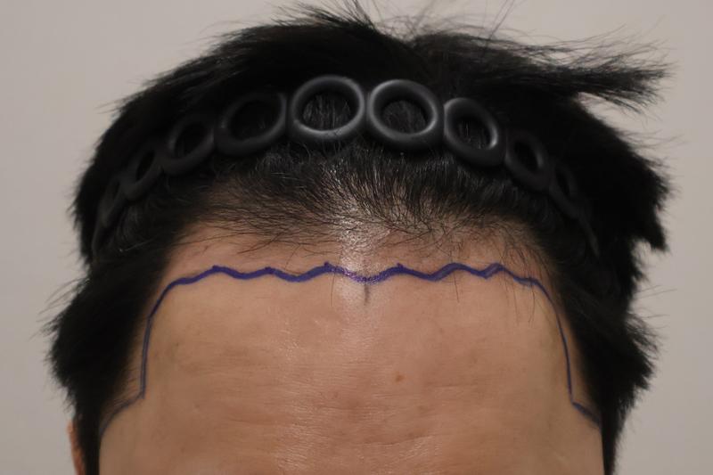 Immediately after surgery for 3,200 non-intersected hairs at Dongtan Hair Clinic