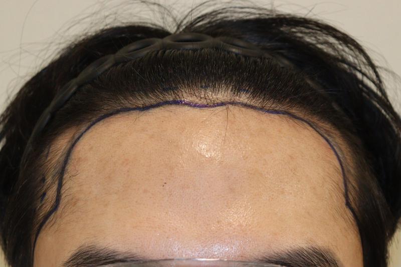 Daegu Hair Orthopedic Clinic Non-Cut 1200 Hair Transplantation 2 Weeks