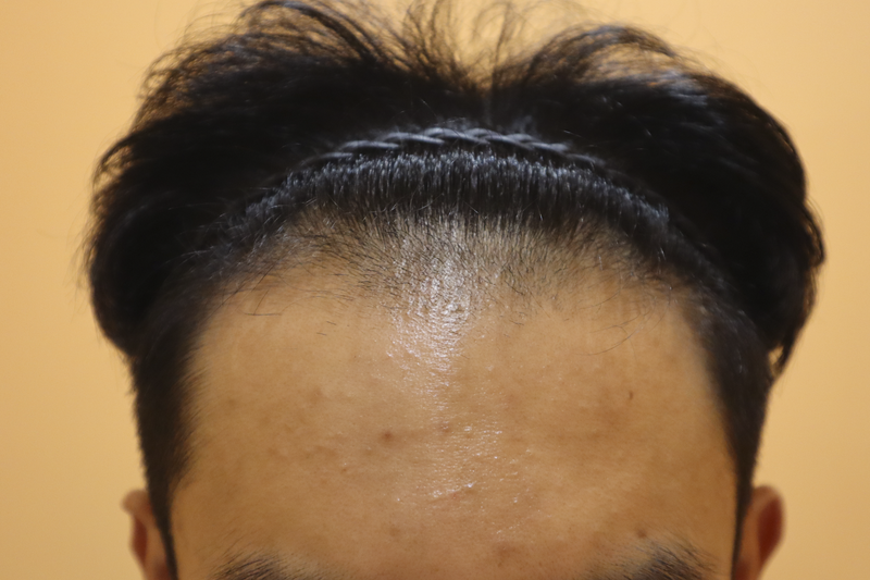 부산 헤어로의원 비절개 모발이식 4000모 2주 경과