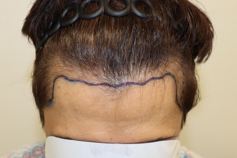 大邱ヘアロ医院 鼻切開 1600毛 手術 9日後記