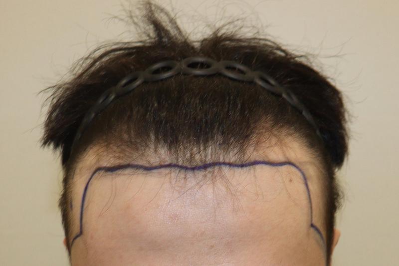 大邱ヘアでビジョルゲ 3000毛 ついに1年後記