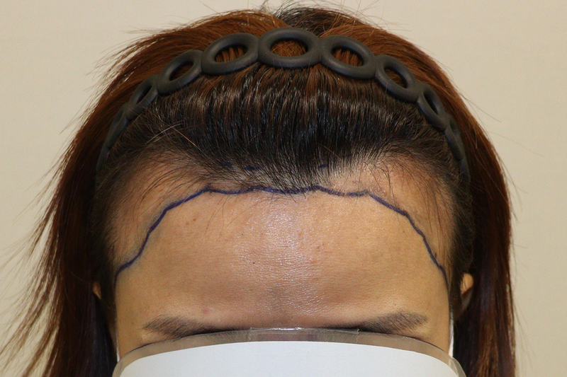 大邱ヘアでビジョルゲ3200毛9ヶ月レビュー(満足！)
