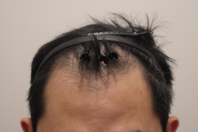 Incheon Maimo Clinic's 2600 hair incision hair transplant 2 weeks later