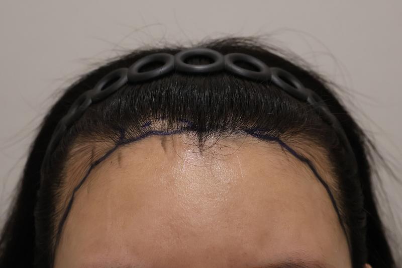 Post-mortem review immediately after surgery for 1,800 hairs at Dongtan Hair Clinic