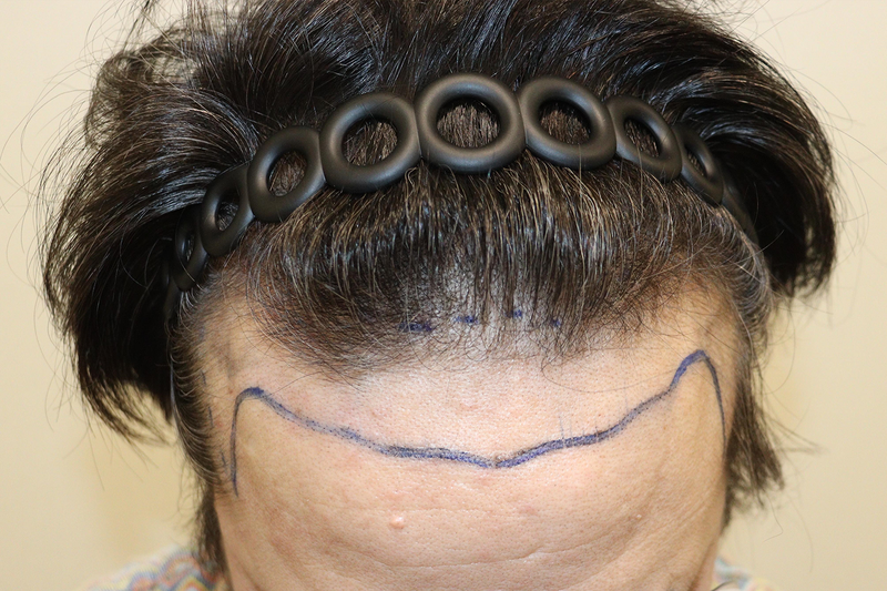 Daegu Hair Leave 2 weeks of non-cut 3,200 Mo at the clinic.
