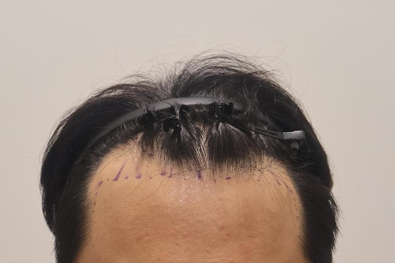 仁川Mymo2400mo非切开已经两周了