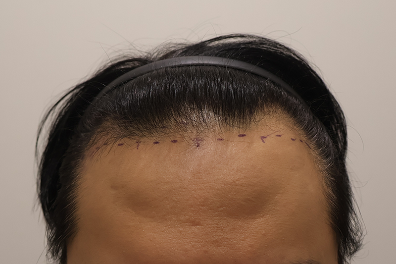 인천마이모의원 비절개 1300모낭 2주경과