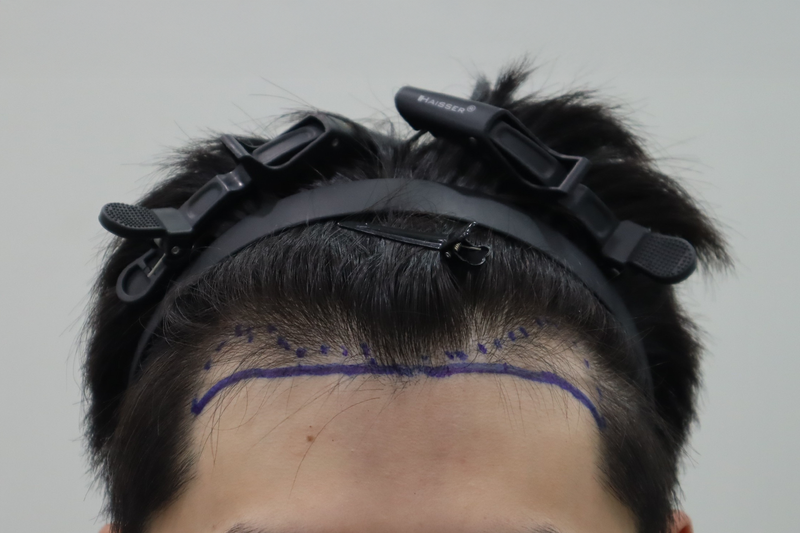 전주 헤어로 M자 탈모 비절개 모발이식 1500모 2주경과 후기