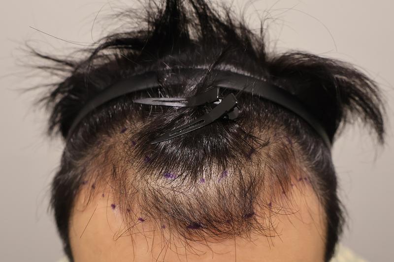 Busan Hairo Clinic's Non-Cutting 1400 Hair Orthopaedes 2 Weeks and Review