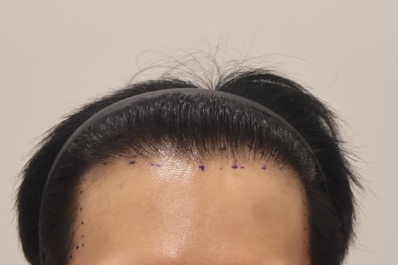 인천 마이모 비절개 모발이식 600모 2주 경과 후기입니다