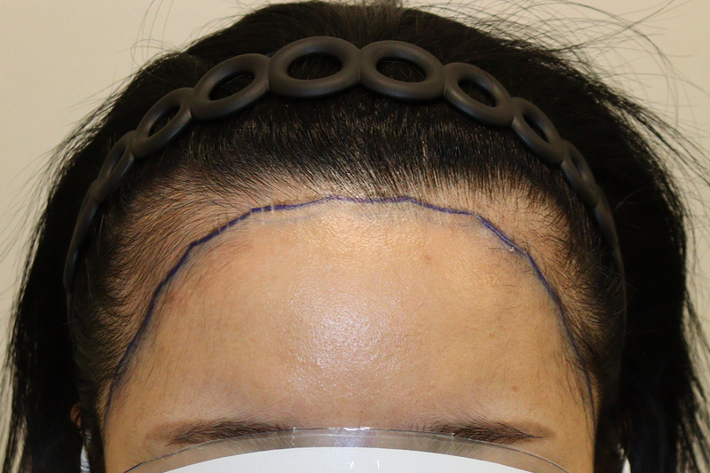 Daegu Hair Orphan Clinic 2000 Hairline Correction Hair Transplantation (Non-Cutting) Successful for 9 Months >_<