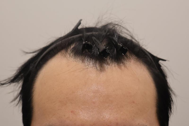 인천 마이모 비절개 모발이식 1400모낭 3개월 경과 후기