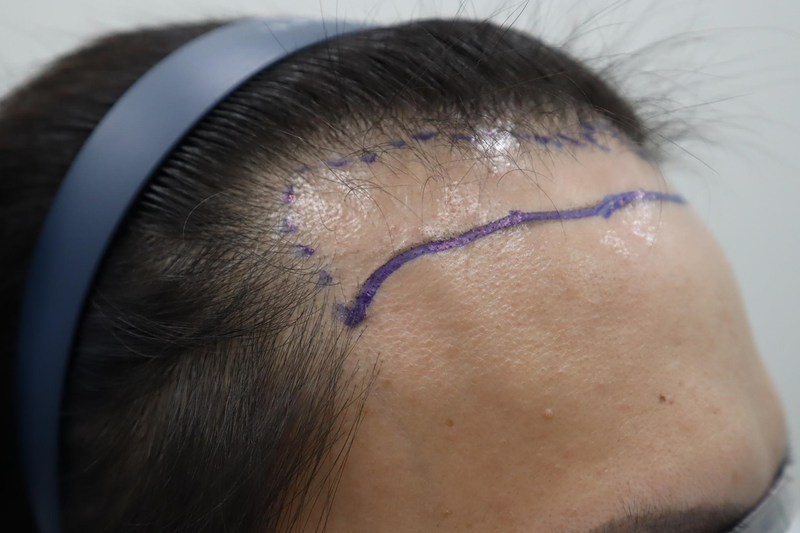 全州ヘアロ医院 非切開 毛髪移植 2200毛 2週間経過後のレビュー