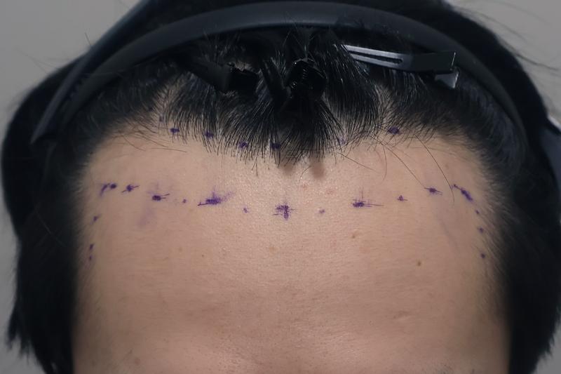 Incheon Maimo Medical Center's non-cut hair transplant 1300 hair follicles for about 2 weeks