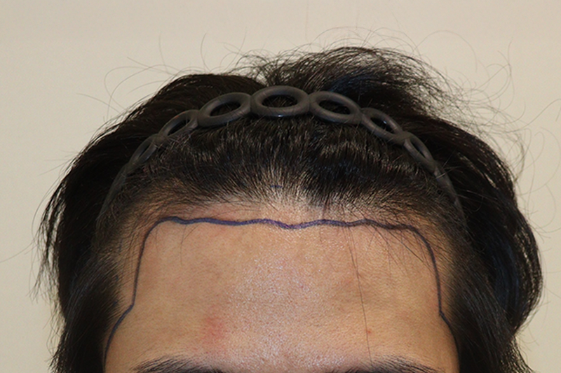 大邱ヘアロ医院 非切開毛髪移植 2300本 2週間経過