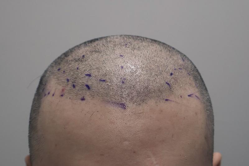 Incheon Maimo Clinic 1400 Hair follicle nasal incision for one month