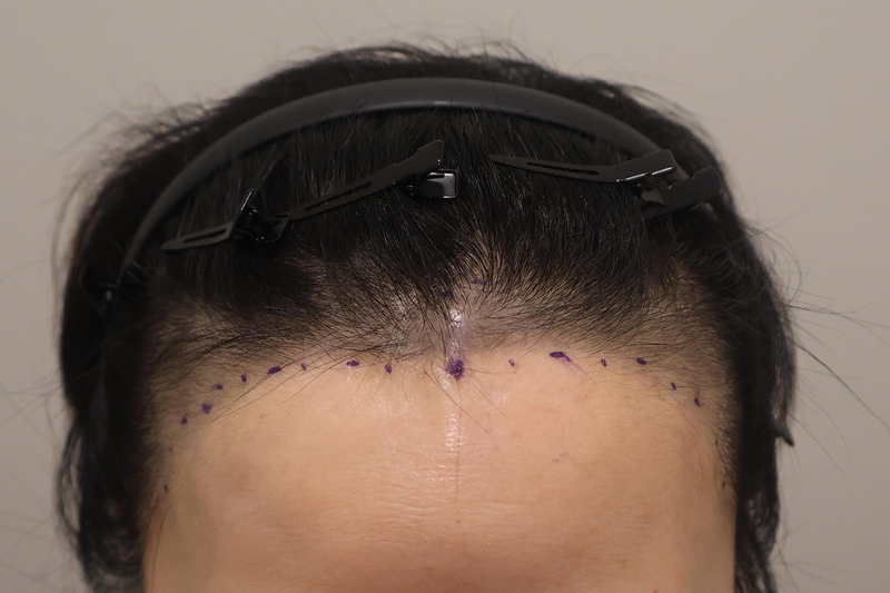 Incheon Maimo incision 2000 Mo 3 months later and the third review