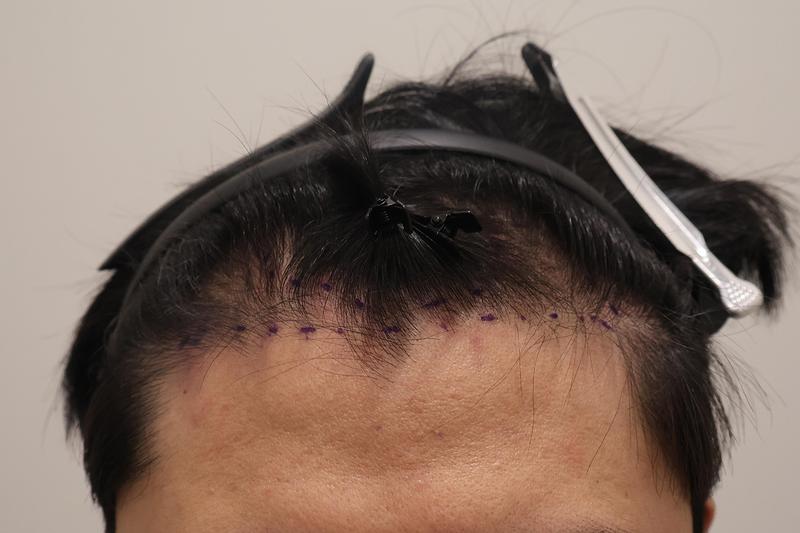 Incheon Maimo Clinic 1,000 Hair Bags Three Months Later