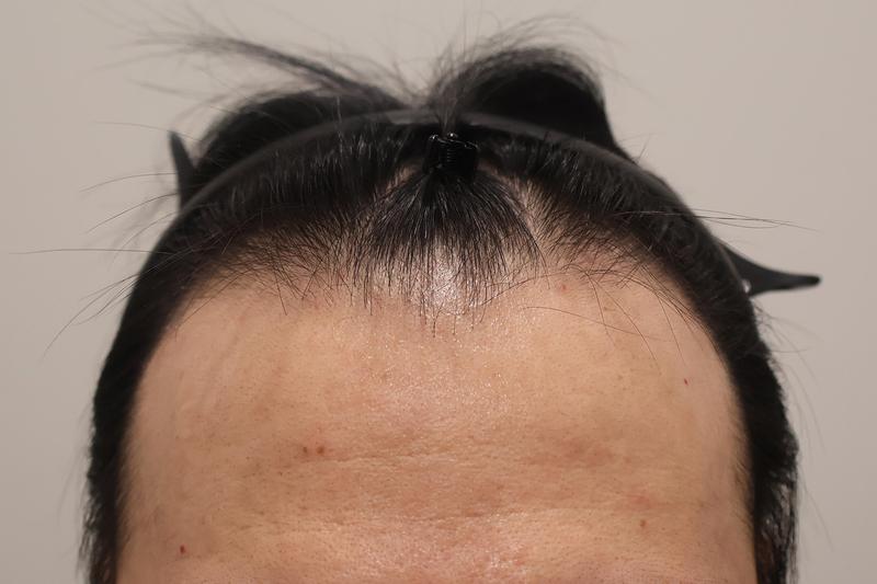 인천마이모의원 비절개 모발이식 800모낭 3개월 경과 후기입니다.
