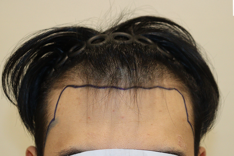 大邱ヘアロ医院 非切開毛髪移植 3000本 2週目のレビューを書いてみます